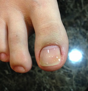 フット補正③ フット補正③