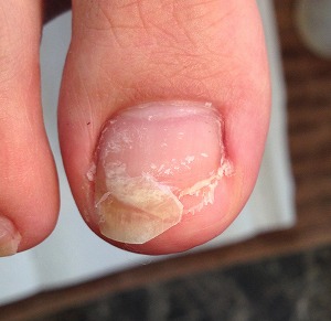 フット補正① フット補正①