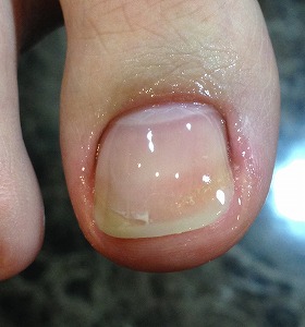 フット補正④ フット補正④