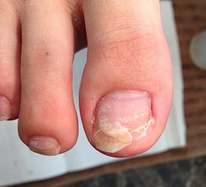 フット補正② フット補正②